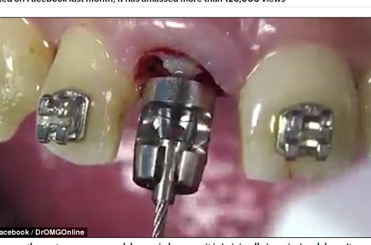 【閲覧注意】精神的にキツイ映像発見! 最新抜歯技術「ベネックス抜歯システム」がヤバイ・痛い・グロい!の画像4