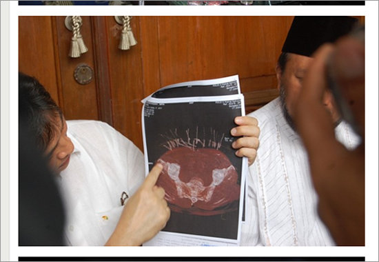 【閲覧注意・奇病】腹から成長する針金が生えてくる女 ― インドネシアのワイヤー・ウーマンの画像3