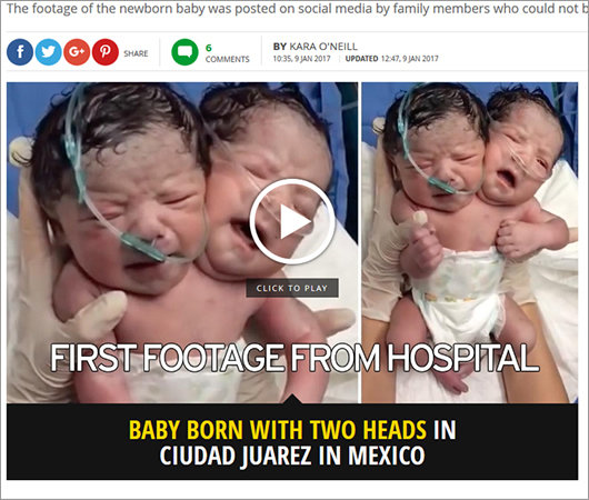 【閲覧注意】体は1つで頭は2つ ― 双頭結合双生児の赤ん坊が誕生=メキシコの画像1