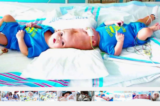 【閲覧注意・奇病】助かった結合双生児、助からなかった結合双生児/アナイアスとジェイドンの画像2