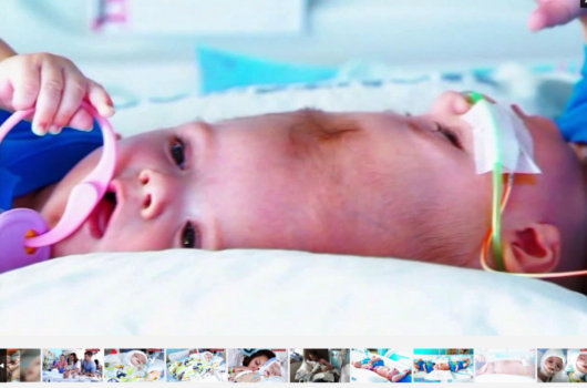 【閲覧注意・奇病】助かった結合双生児、助からなかった結合双生児/アナイアスとジェイドンの画像3