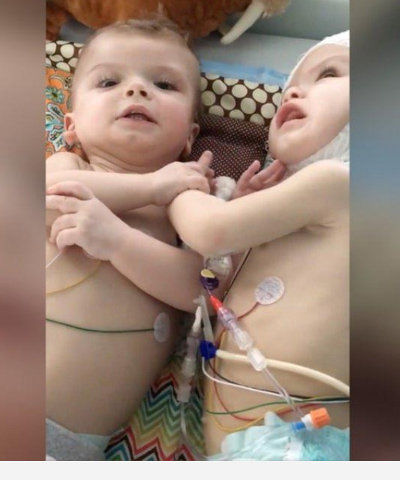 【閲覧注意・奇病】助かった結合双生児、助からなかった結合双生児/アナイアスとジェイドンの画像4