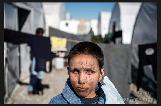 空爆で両目が完全に潰れたシリア少年! カメラに向けられた瞳なき眼差しに心を揺さぶられる!の画像3