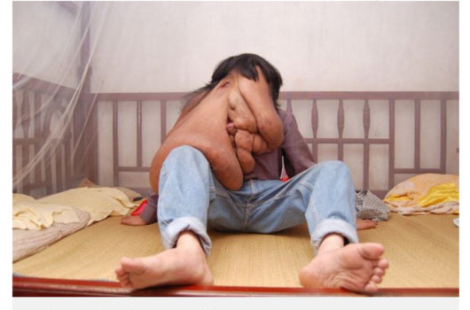 【閲覧注意・奇病】体の半分が顔になった男 ― 絶対絶望のエレファントマンの悲劇=中国の画像4