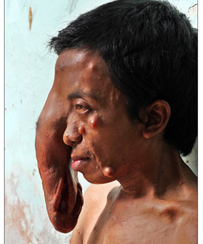 【閲覧注意】腫瘍の中に埋もれた目玉がギョロリ…!どこまでも垂れ下がる右目をもつ男=フィリピンの画像1