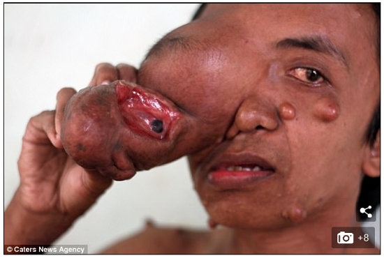 【閲覧注意】腫瘍の中に埋もれた目玉がギョロリ…!どこまでも垂れ下がる右目をもつ男=フィリピンの画像3