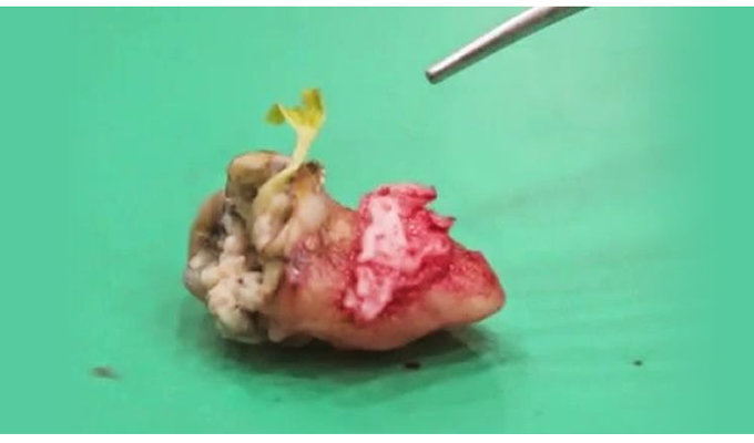 【閲覧注意】人間の体内から発見されたゾッとするほど身の毛もよだつ生命体5選! ウジ虫から種子まで!の画像9