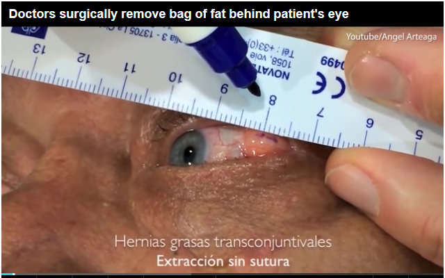 1709_eyeballsurgery_1.jpg