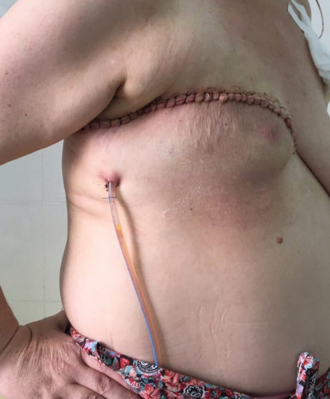 【閲覧注意】史上最悪の乳がんと謳われた腫瘍 — 胸に咲いた世界一残酷な花の画像1