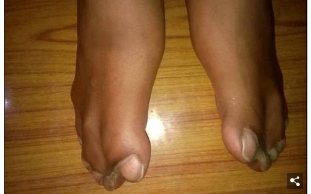 【閲覧注意】水掻きに吸収合併された手足の指! 頭蓋骨まで変形… 奇病「アペール症候群」の少年に驚愕=インドの画像3