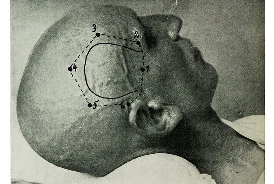 【閲覧注意】100年前の脳外科手術が恐すぎる!! 麻酔なしで頭蓋骨にドリル突き刺し、穴から針を挿入して…！の画像1