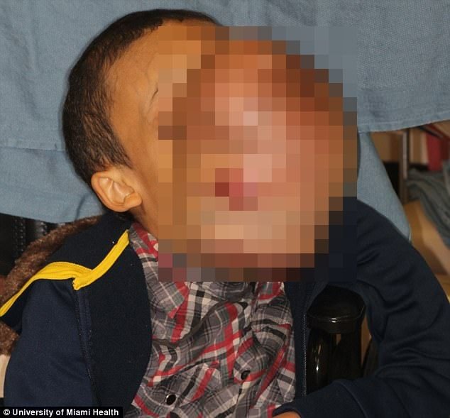 【閲覧注意】10ポンドの巨大腫瘍に顔を乗っ取られた14歳少年！ 多骨性線維性骨異形成症で苦しむ少年、今月手術実施への画像1