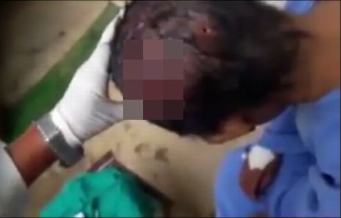 【閲覧注意】後頭部に3つの穴…頭がボーリング玉になった創傷蝿蛆男の悲劇! 頭の傷を放置してはいけない!の画像1
