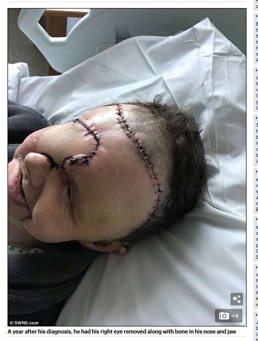【閲覧注意】手術で顔面に大穴が空いた男! 恐ろしい姿に絶叫する孫娘、穴から流れる体液… 良きパパを襲った地獄の苦しみとは?の画像4