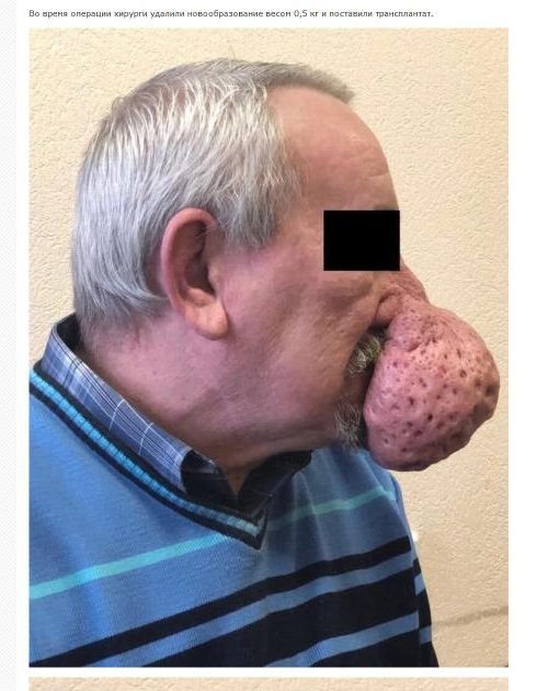 【閲覧注意】世界最悪の団子っ鼻がマジで衝撃的すぎる! 巨大「鼻コブ」で呼吸や飲食もままならず…!=ロシアの画像2