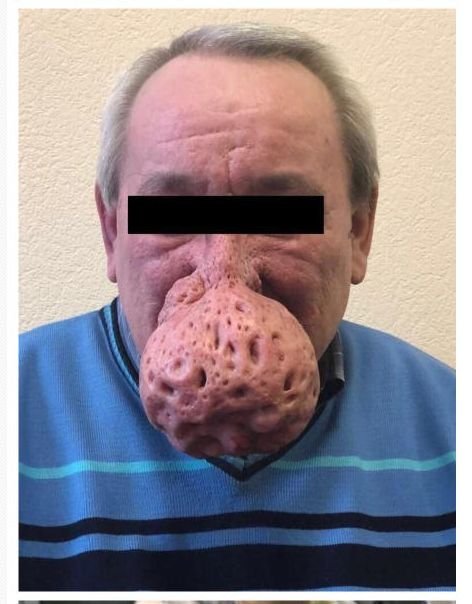 【閲覧注意】世界最悪の団子っ鼻がマジで衝撃的すぎる! 巨大「鼻コブ」で呼吸や飲食もままならず…!=ロシアの画像3