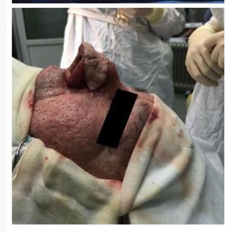 【閲覧注意】世界最悪の団子っ鼻がマジで衝撃的すぎる! 巨大「鼻コブ」で呼吸や飲食もままならず…!=ロシアの画像4