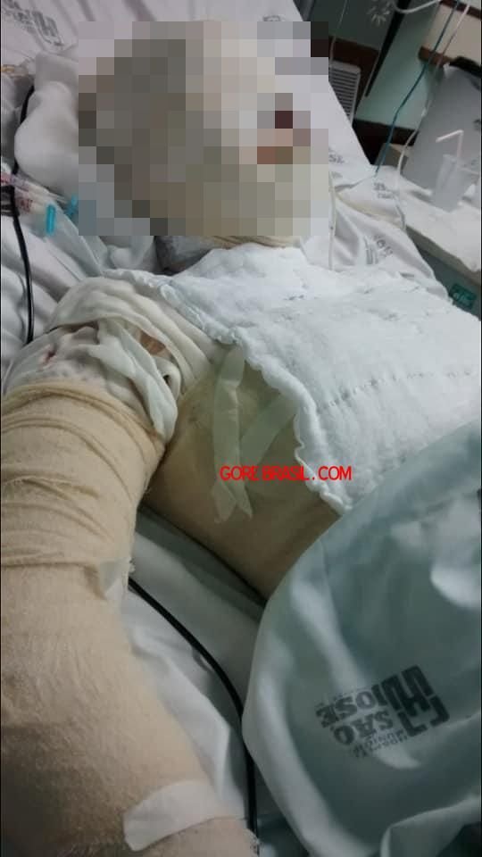 【閲覧注意】鬼畜夫に強酸を浴びせられた美女の完全崩壊した顔面が悲しすぎる! 目鼻口が溶け… 超卑劣「アシッドアタック」の実態の画像1