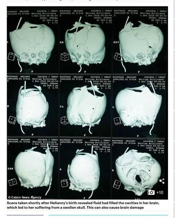 【閲覧注意】頭に王冠が埋め込まれた顔面奇形の赤ん坊! 誕生前から医師に見放され… 奇形児の出産責任が議論=ベネズエラの画像2