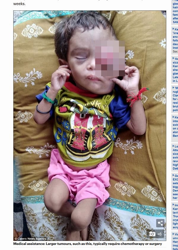 【閲覧注意】がんで目玉が完全に飛び出た2歳男児の苦悶の涙…! 治療費捻出できない両親は路上生活に=パキスタンの画像1