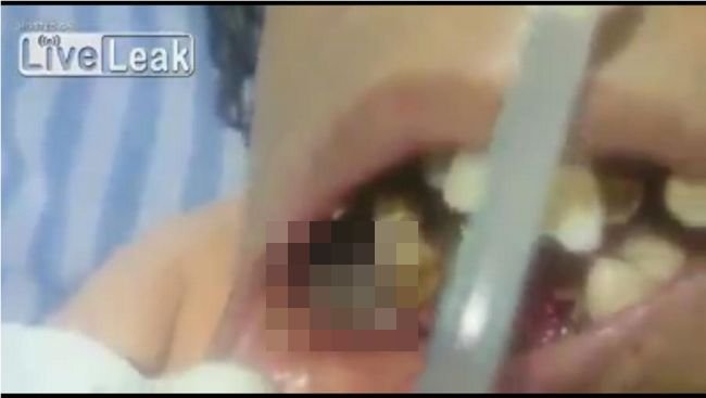 【閲覧注意】虫歯を完全放置した女を襲ったウジ虫歯の恐怖！ ウジが口から溢れ出る最悪の「口腔内蠅蛆症」！の画像1