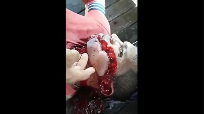 【閲覧注意】銃弾が頬をかすめるとこうなる! あなたの想像以上にエグい光景!=ブラジルの画像2