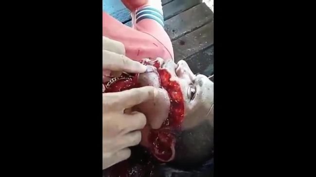 【閲覧注意】銃弾が頬をかすめるとこうなる! あなたの想像以上にエグい光景!=ブラジルの画像3