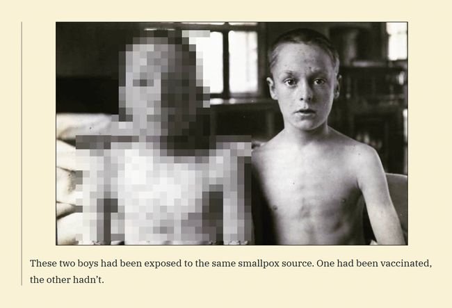 【閲覧注意】あの有名な天然痘少年2人の「鳥肌級」衝撃写真、フェイクではなく本物だった！ ワクチン未接種のヤバさ歴然!!の画像1