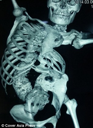 【閲覧注意】ねじれすぎた娘 ― 先天性脊柱側弯症の困難＝インドの画像1