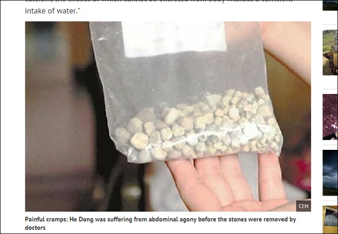 420KidneyStones_2.jpg