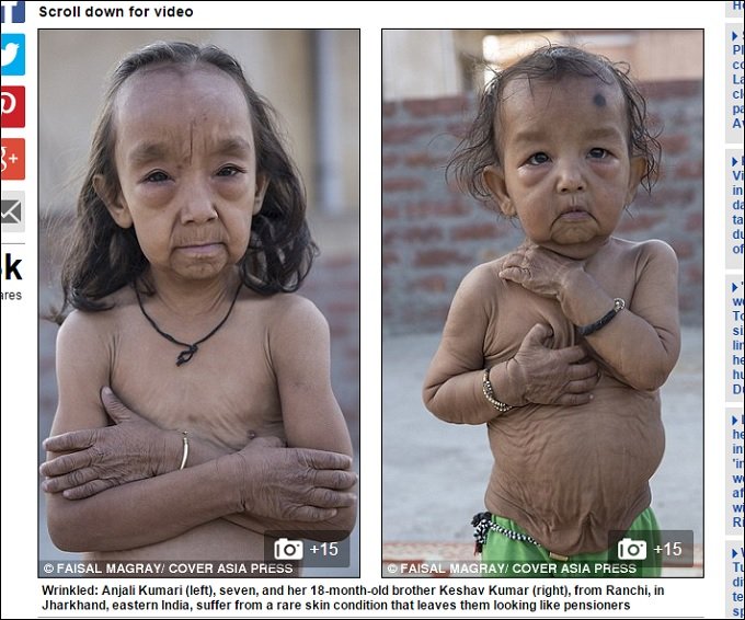 老人として生まれた幼児 ― 「早老症」と「皮膚弛緩症」併発という残酷すぎる現実＝インドの画像2