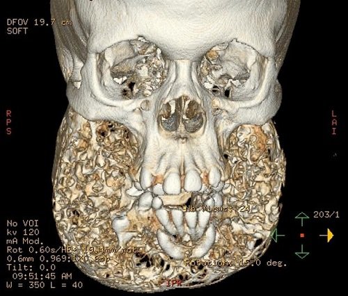 Cherubism_expanded_mandible.jpg