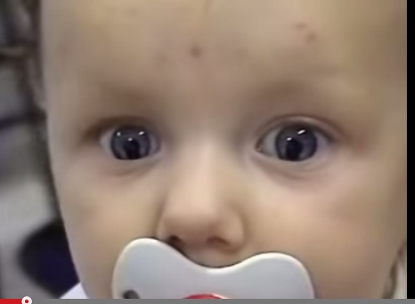 Coloboma.jpg