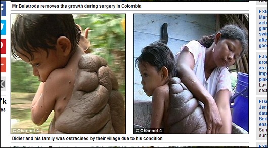 背中に巨大な甲羅を持つカメ少年 ― 切除手術に成功し患者たちへ希望を届ける！の画像1