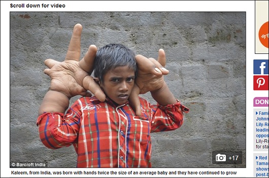 「育ちすぎる巨大な手」を持つ8歳の少年 ― 膨張が止まらぬ謎の症状に医師も困惑＝インドの画像1