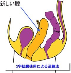 【やや閲覧注意】実録!タイの性器事情 ニューハーフになるためのすべての画像3