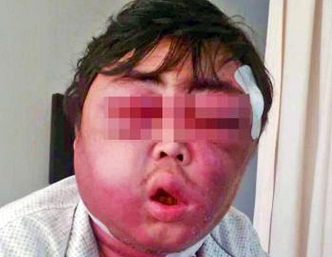 MosquitoBite_2.jpg