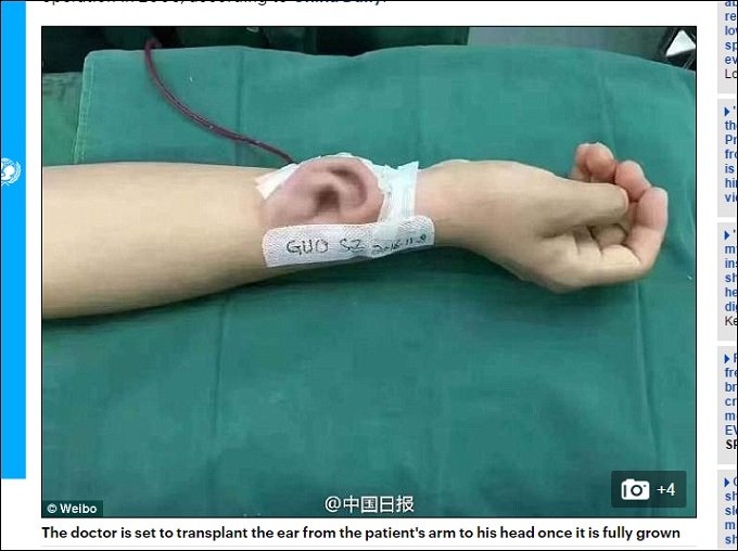 失った耳を腕で培養して再建→側頭部にくっつけて完成! 最先端外科手術の様子がキモスゴい=中国の画像2