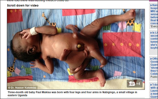 ParasiticTwin.jpg