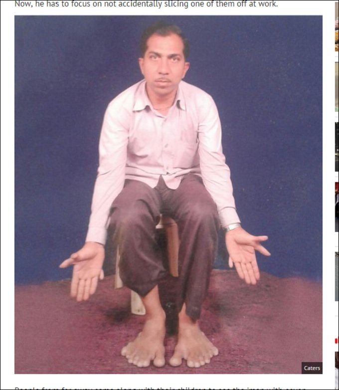 Polydactylism_2.jpg