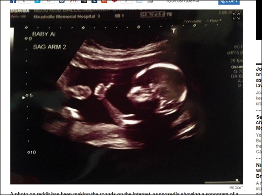 【不思議】胎児がエコー検査に気付いてポージング？ 赤ちゃんは外が見えているのか？の画像1