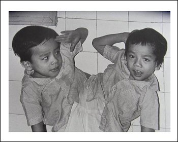 【閲覧注意】生まれた我が子は双頭の赤ん坊だった… 原因不明の奇形児続発に戦慄!=インドの画像2