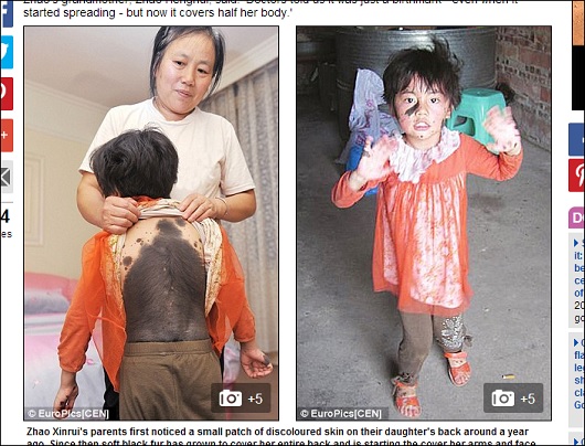 「猫娘」と差別される6歳の少女 ― 全身を覆い尽くす体毛と、深く刻まれた心の傷＝中国の画像1