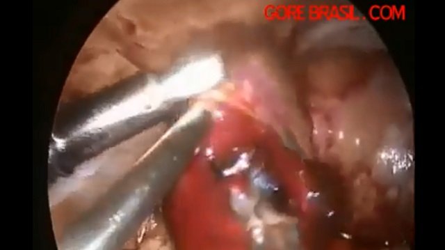 【閲覧注意】中絶手術を嫌がる胎児の映像! 手術器具を避けようとする胎児の姿が悲しすぎる!の画像1
