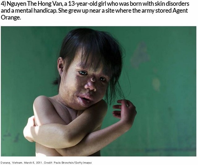 “3世代”にわたり奇形児が生まれ続けるベトナム戦争「枯葉剤」の悲劇写真10選！ のっぺらぼう、顔面崩壊… 米国の残酷な戦争犯罪とは？