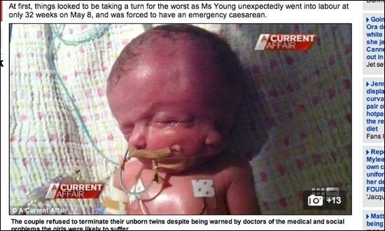 【閲覧注意・奇病】助かった結合双生児、助からなかった結合双生児/アナイアスとジェイドンの画像5