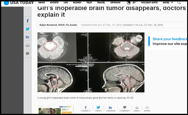 余命9カ月少女の脳腫瘍が突然消失…説明不可能な事態に医師唖然「信じられない！」 祈っただけで…証拠画像アリ！の画像3