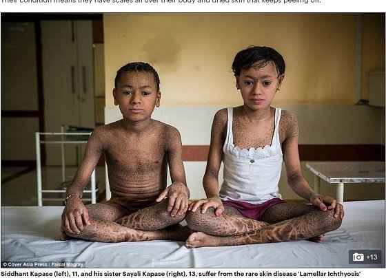 ウロコで全身を覆われた姉弟 皮膚がひび割れ 剥がれ落ちる難病と徹底的差別の実態 インド
