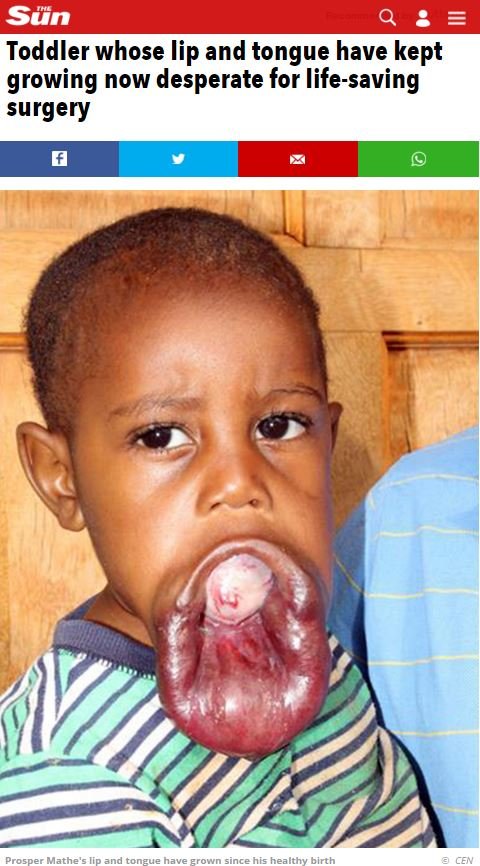 【閲覧注意】南アフリカの口裂け少年 ― 命を脅かす制御不能の唇の画像2