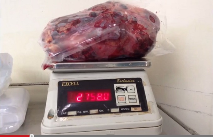 【閲覧注意】摘出された世界最大の腎臓がグロすぎる!! 放置すると恐ろしい「ADPKD」の末路=インドの画像2